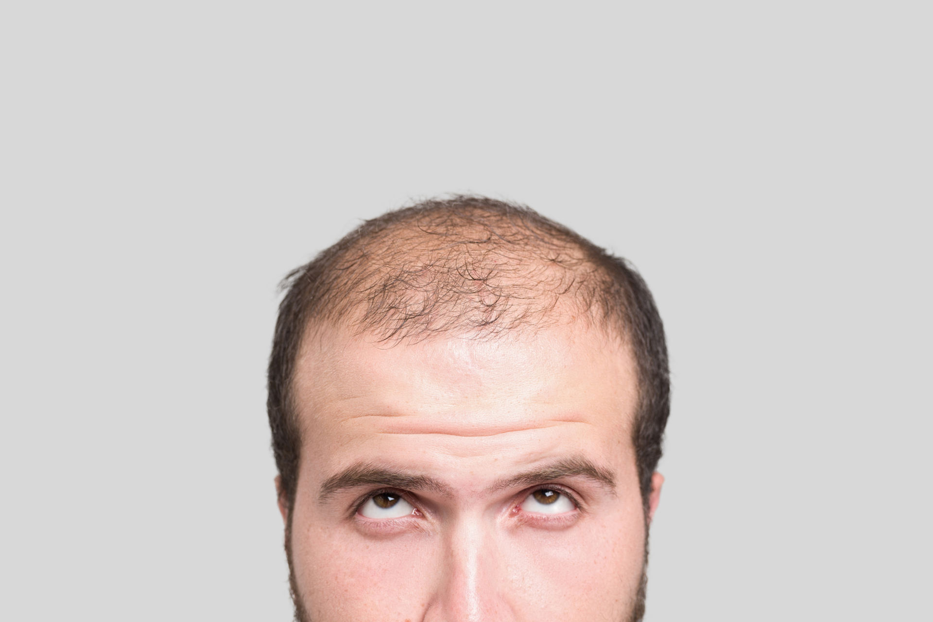Haarausfall bei Männern - Was ist die Ursache?